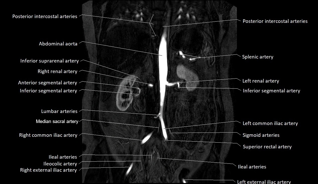 MRA Abdomen coronal anatomy image 24.webp
